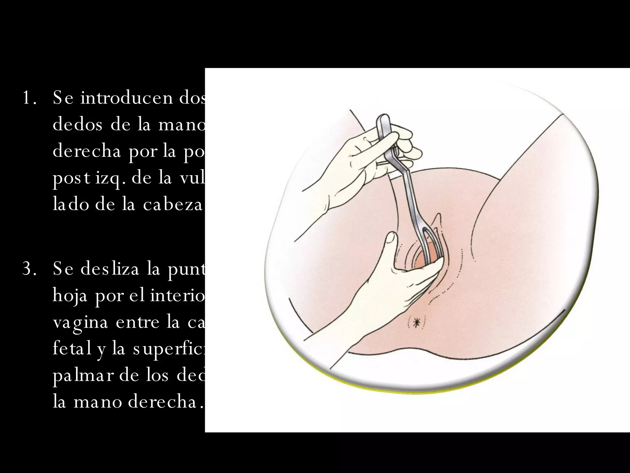 Se introducen dos o mas dedos de la mano derecha por la porción post izq. de la vulva a lado de la cabeza fetal. Se desliza la punta de la hoja por el interior de la vagina entre la cabeza fetal y la superficie palmar de los dedos de la mano derecha.(guías) 