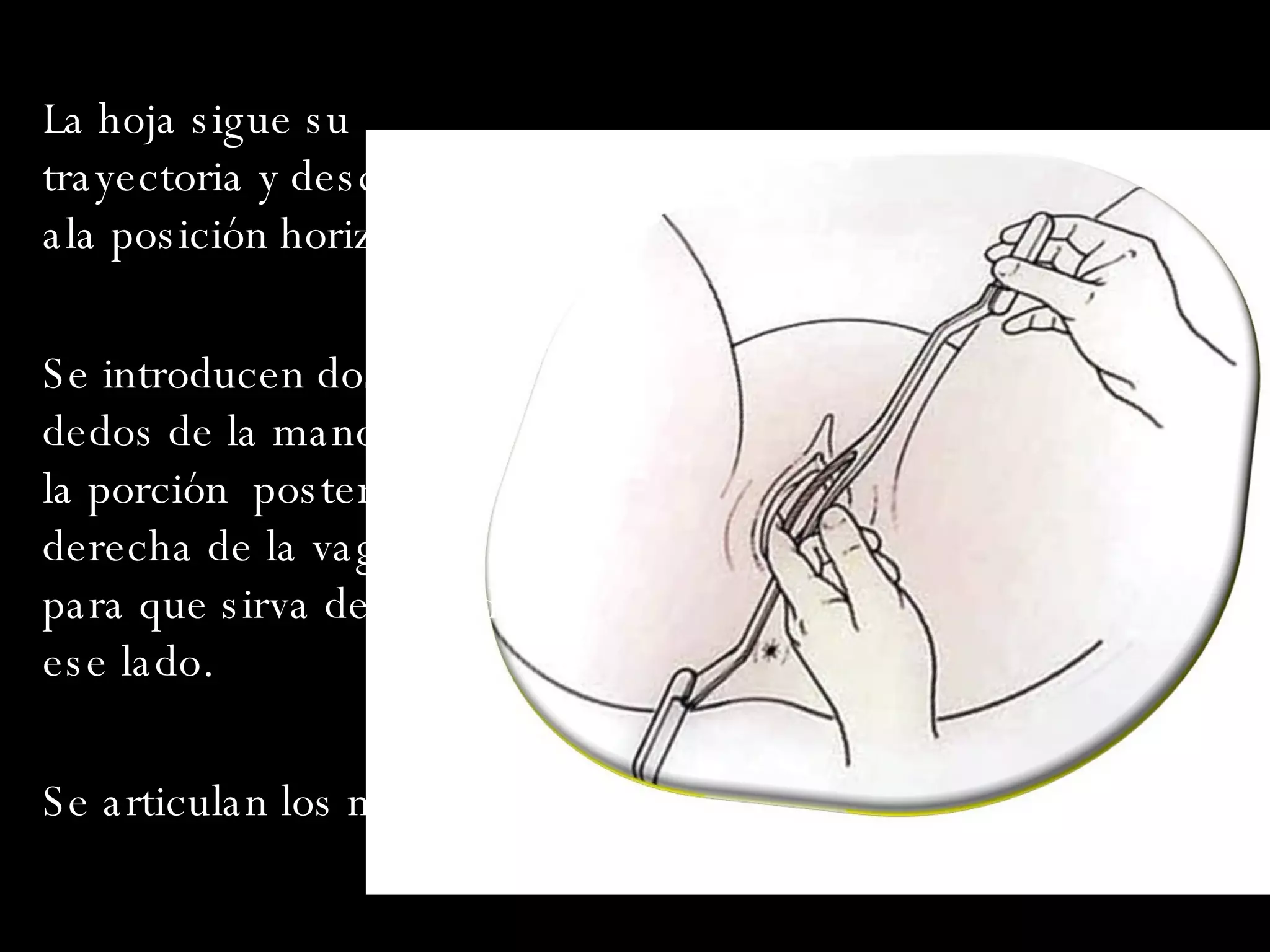 La hoja sigue su trayectoria y desciende ala posición horizontal Se introducen dos o mas dedos de la mano izq. En la porción  posterior derecha de la vagina para que sirva de guía de ese lado. Se articulan los mangos . 