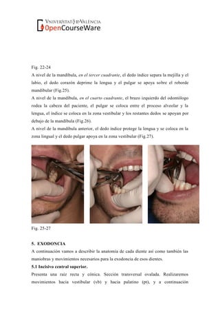 Fig. 22-24
A nivel de la mandíbula, en el tercer cuadrante, el dedo índice separa la mejilla y el
labio, el dedo corazón deprime la lengua y el pulgar se apoya sobre el reborde
mandibular (Fig.25).
A nivel de la mandíbula, en el cuarto cuadrante, el brazo izquierdo del odontólogo
rodea la cabeza del paciente, el pulgar se coloca entre el proceso alveolar y la
lengua, el índice se coloca en la zona vestibular y los restantes dedos se apoyan por
debajo de la mandíbula (Fig.26).
A nivel de la mandíbula anterior, el dedo índice protege la lengua y se coloca en la
zona lingual y el dedo pulgar apoya en la zona vestibular (Fig.27).
Fig. 25-27
5. EXODONCIA
A continuación vamos a describir la anatomía de cada diente así como también las
maniobras y movimientos necesarios para la exodoncia de esos dientes.
5.1 Incisivo central superior.
Presenta una raíz recta y cónica. Sección transversal ovalada. Realizaremos
movimientos hacia vestibular (vb) y hacia palatino (pt), y a continuación
 