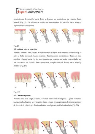 movimientos de rotación hacia distal y después un movimiento de rotación hacia
mesial (Fig.28). Por último se realiza un movimiento de tracción hacia abajo y
ligeramente hacia delante.
Fig. 28
5.2 Incisivo lateral superior.
Presenta una raíz fina y corta. Con frecuencia el ápice está curvado hacia distal y la
raíz se halla inclinada hacia palatino. Realizaremos movimientos hacia pt más
amplios y luego hacia vb, los movimientos de rotación se harán con cuidado por
las curvaturas de la raíz. Traccionaremos, desplazando el diente hacia abajo y
delante (Fig.29).
Fig. 29
5.3 Canino superior.
Presenta una raíz larga y fuerte. Sección transversal triangular. Ligera curvatura
hacia distal del ápice. Movimientos hacia vb con precaución por el mínimo espesor
de la cortical y hacia pt, finalizando con una ligera tracción hacia abajo (Fig.30).
 