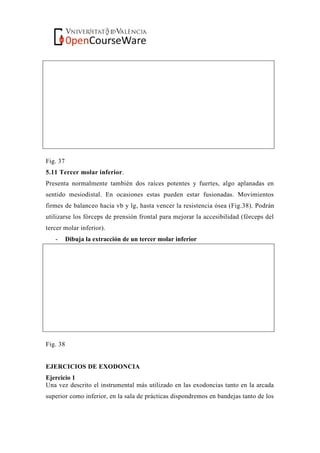 Fig. 37
5.11 Tercer molar inferior.
Presenta normalmente también dos raíces potentes y fuertes, algo aplanadas en
sentido mesiodistal. En ocasiones estas pueden estar fusionadas. Movimientos
firmes de balanceo hacia vb y lg, hasta vencer la resistencia ósea (Fig.38). Podrán
utilizarse los fórceps de prensión frontal para mejorar la accesibilidad (fórceps del
tercer molar inferior).
- Dibuja la extracción de un tercer molar inferior
Fig. 38
EJERCICIOS DE EXODONCIA
Ejercicio 1
Una vez descrito el instrumental más utilizado en las exodoncias tanto en la arcada
superior como inferior, en la sala de prácticas dispondremos en bandejas tanto de los
 