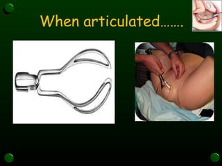 Presentation on Forceps delivery . ppt | PPT