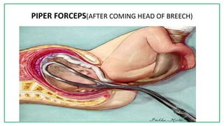 7C
PIPER FORCEPS(AFTER COMING HEAD OF BREECH)
 