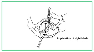 7C
Application of right blade
 