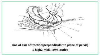 7C
Line of axis of traction(perpendicular to plane of pelvis)
1-high2-mid3-low4-outlet
 