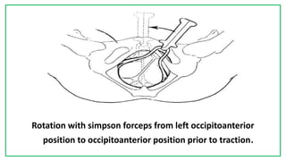 7C
Rotation with simpson forceps from left occipitoanterior
position to occipitoanterior position prior to traction.
 
