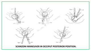 7C
SCANZONI MANEUVER IN OCCIPUT POSTERIOR POSITION.
 