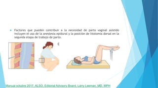  Factores que pueden contribuir a la necesidad de parto vaginal asistido
incluyen el uso de la anestesia epidural y la posición de litotomía dorsal en la
segunda etapa de trabajo de parto.

Manual octubre 2017, ALSO, Editorial Advisory Board, Larry Leeman, MD, MPH
 