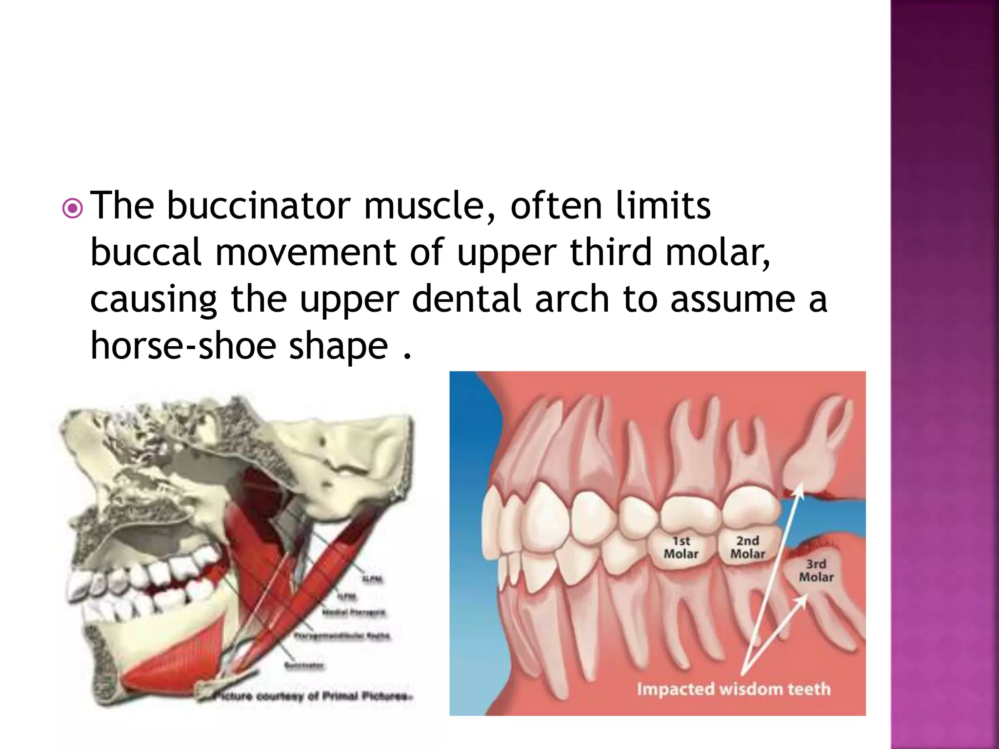  The buccinator muscle, often limits
buccal movement of upper third molar,
causing the upper dental arch to assume a
horse-shoe shape .
 
