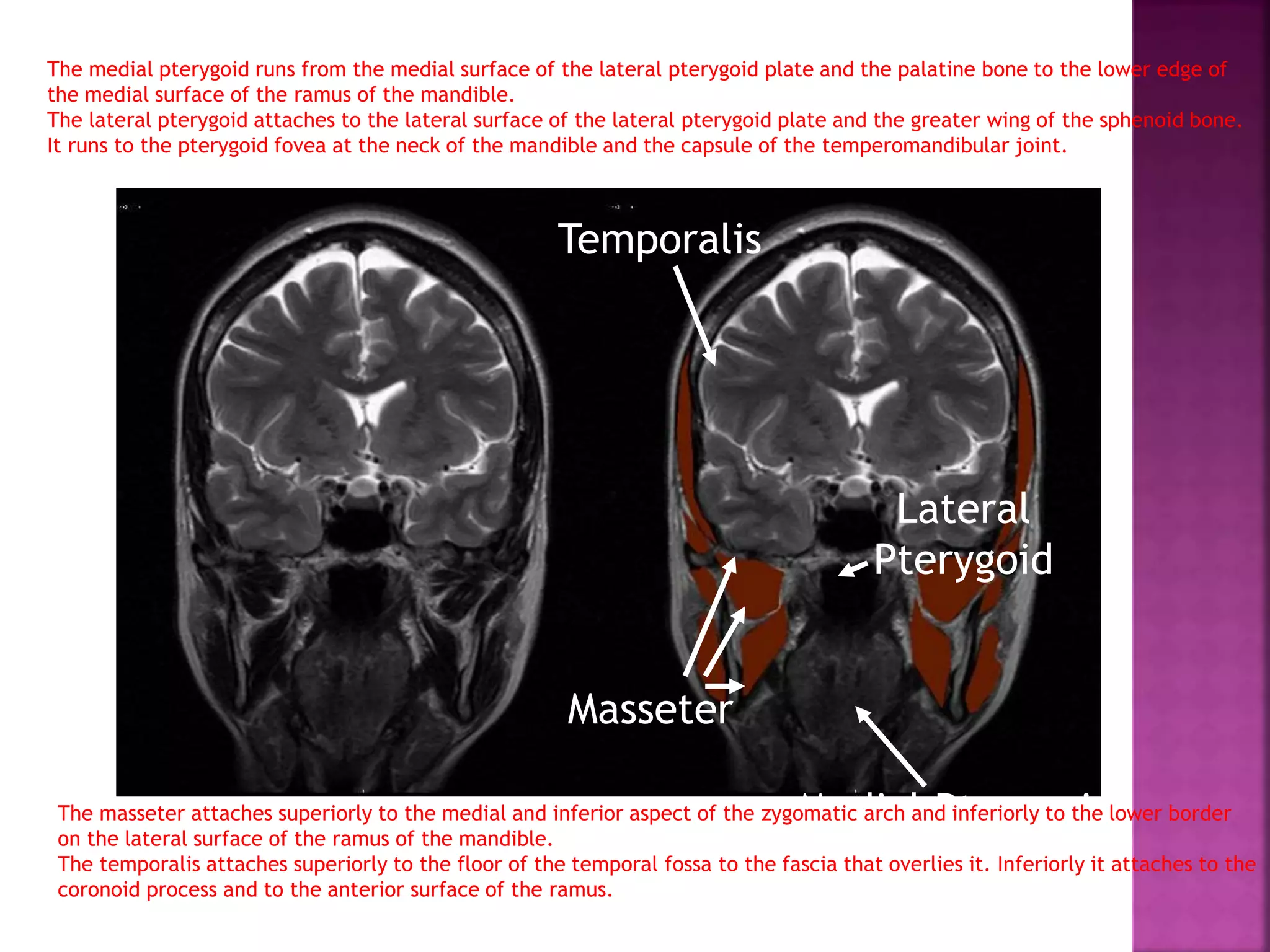Masseter
Temporalis
Medial PterygoidThe masseter attaches superiorly to the medial and inferior aspect of the zygomatic arch and inferiorly to the lower border
on the lateral surface of the ramus of the mandible.
The temporalis attaches superiorly to the floor of the temporal fossa to the fascia that overlies it. Inferiorly it attaches to the
coronoid process and to the anterior surface of the ramus.
The medial pterygoid runs from the medial surface of the lateral pterygoid plate and the palatine bone to the lower edge of
the medial surface of the ramus of the mandible.
The lateral pterygoid attaches to the lateral surface of the lateral pterygoid plate and the greater wing of the sphenoid bone.
It runs to the pterygoid fovea at the neck of the mandible and the capsule of the temperomandibular joint.
Lateral
Pterygoid
 
