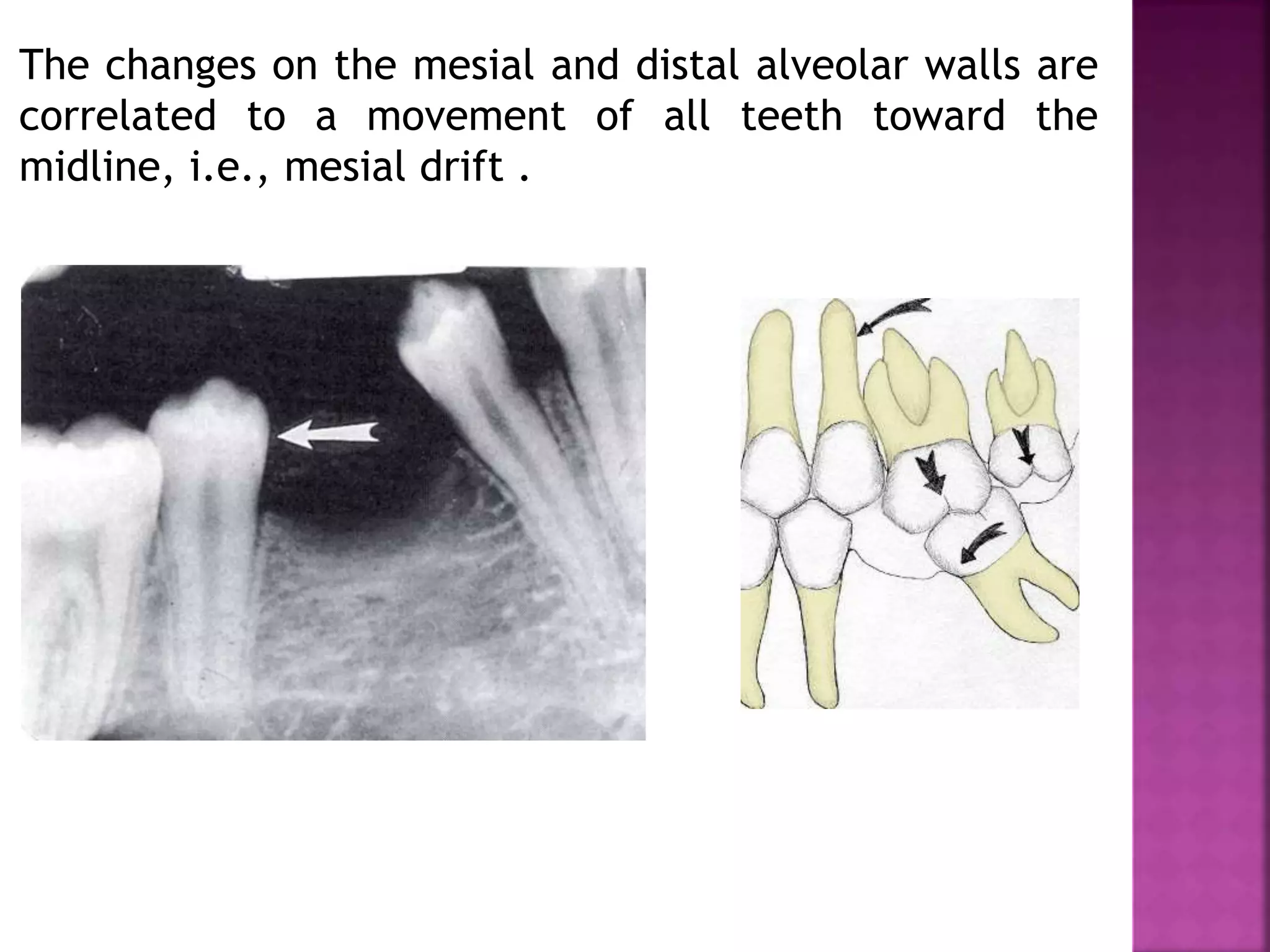 The changes on the mesial and distal alveolar walls are
correlated to a movement of all teeth toward the
midline, i.e., mesial drift .
 