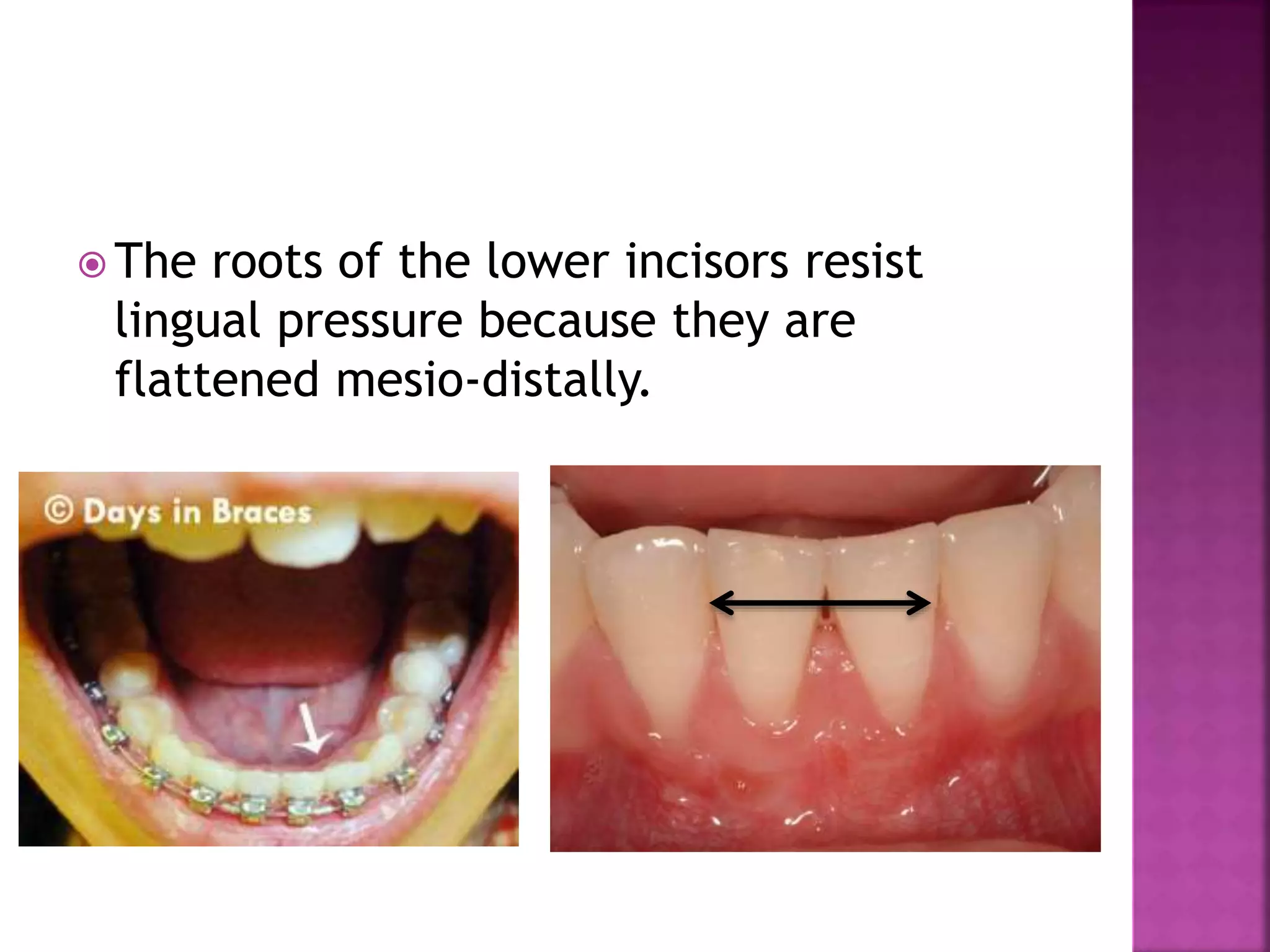  The roots of the lower incisors resist
lingual pressure because they are
flattened mesio-distally.
 