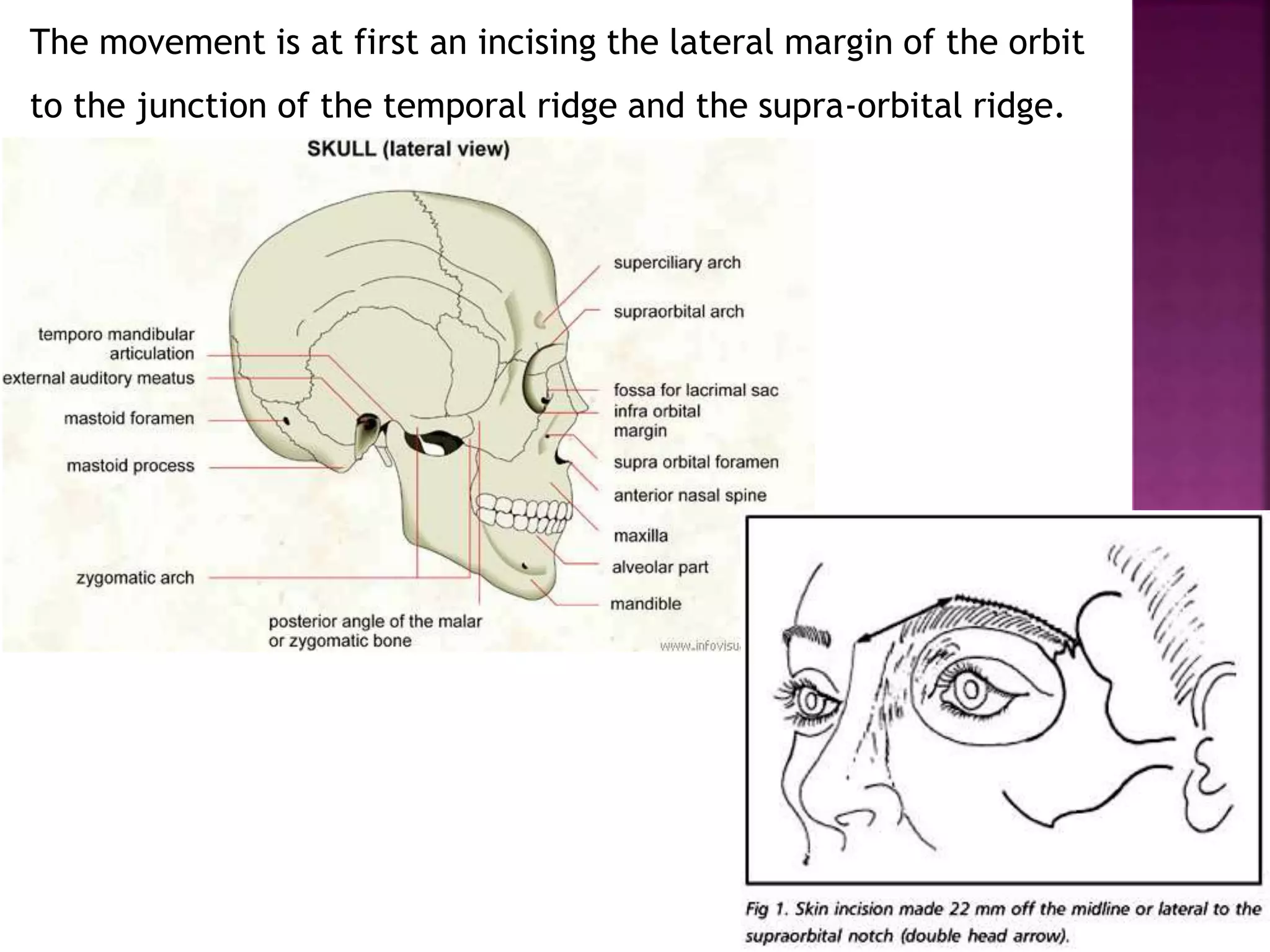 The movement is at first an incising the lateral margin of the orbit
to the junction of the temporal ridge and the supra-orbital ridge.
 