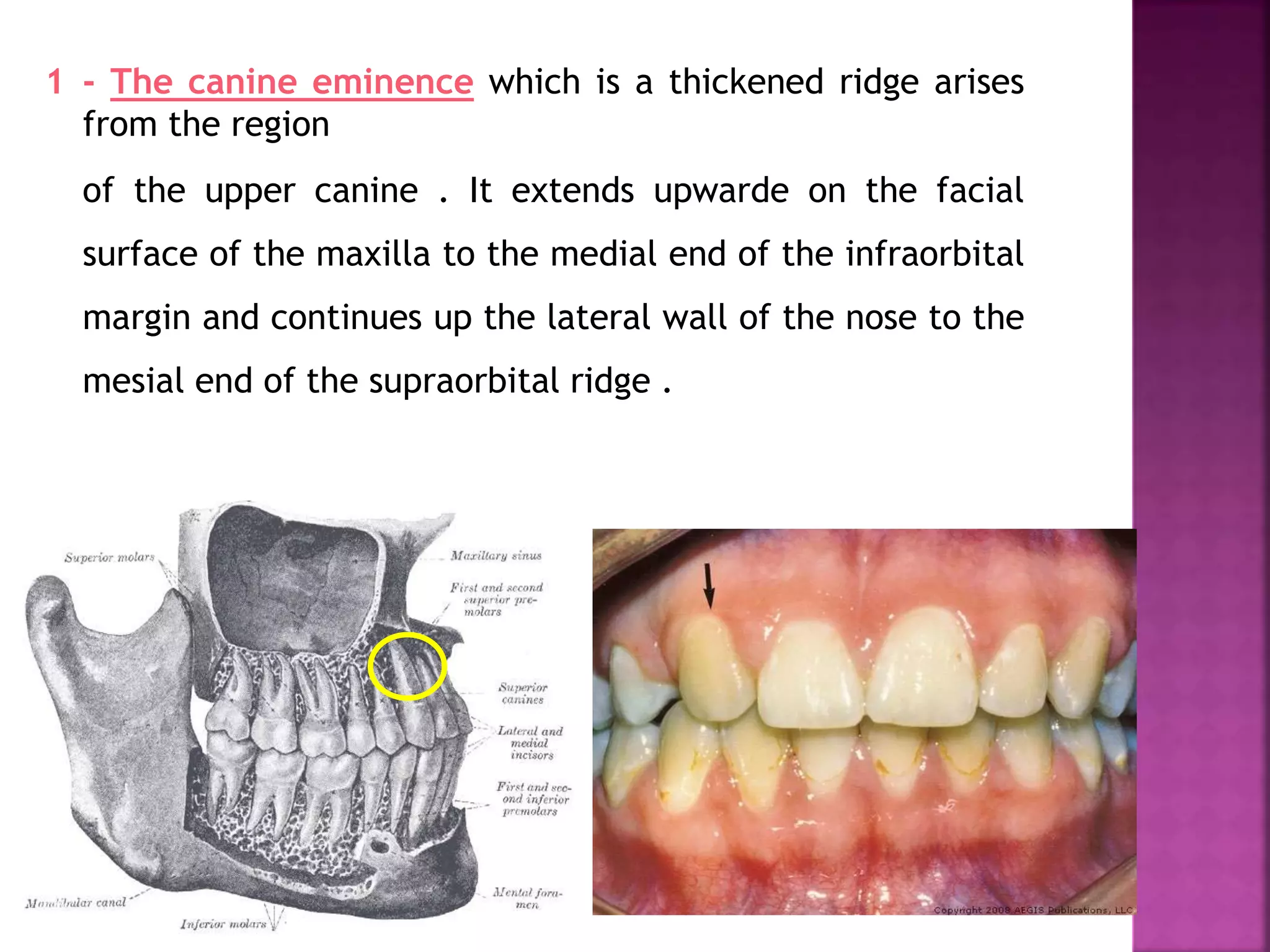 1 - The canine eminence which is a thickened ridge arises
from the region
of the upper canine . It extends upwarde on the facial
surface of the maxilla to the medial end of the infraorbital
margin and continues up the lateral wall of the nose to the
mesial end of the supraorbital ridge .
 