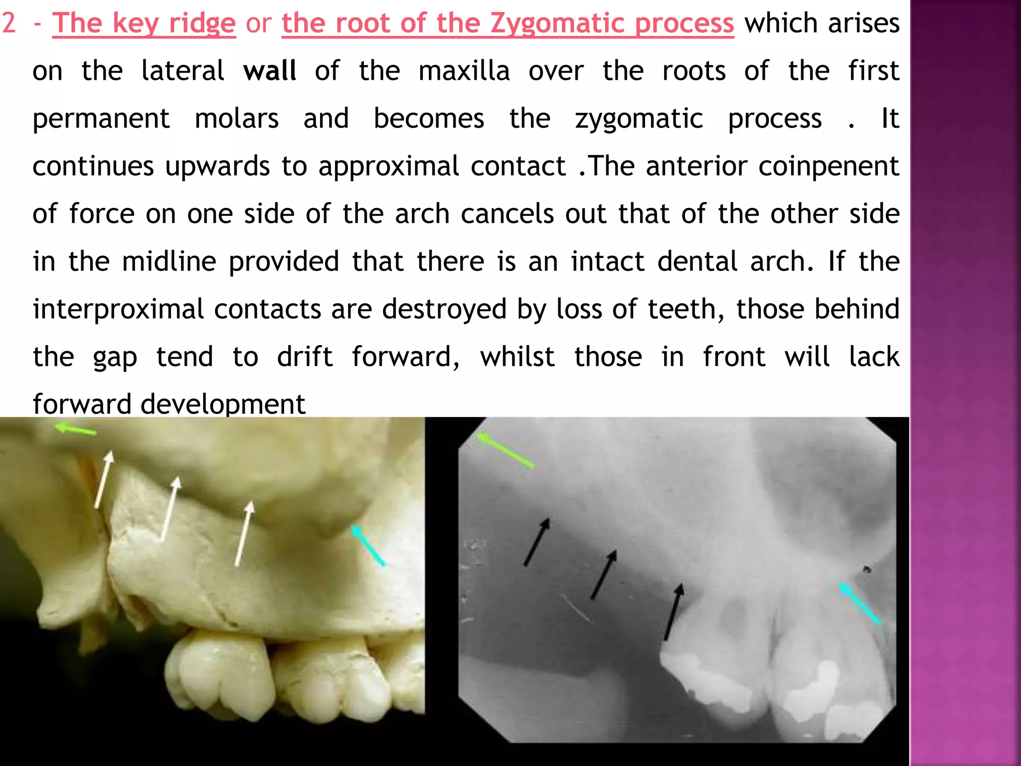 2 - The key ridge or the root of the Zygomatic process which arises
on the lateral wall of the maxilla over the roots of the first
permanent molars and becomes the zygomatic process . It
continues upwards to approximal contact .The anterior coinpenent
of force on one side of the arch cancels out that of the other side
in the midline provided that there is an intact dental arch. If the
interproximal contacts are destroyed by loss of teeth, those behind
the gap tend to drift forward, whilst those in front will lack
forward development
 