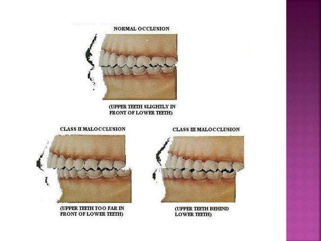 Forces of occlusion.ppt