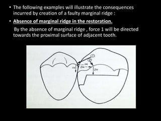 • The following examples will illustrate the consequences
incurred by creation of a faulty marginal ridge :
• Absence of marginal ridge in the restoration.
By the absence of marginal ridge , force 1 will be directed
towards the proximal surface of adjacent tooth.
 