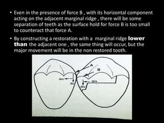 • Even in the presence of force B , with its horizontal component
acting on the adjacent marginal ridge , there will be some
separation of teeth as the surface hold for force B is too small
to counteract that force A.
• By constructing a restoration with a marginal ridge lower
than the adjacent one , the same thing will occur, but the
major movement will be in the non restored tooth.
 