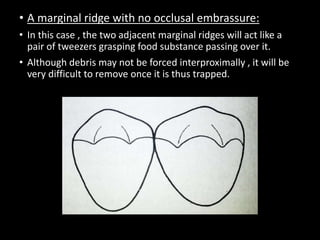 • A marginal ridge with no occlusal embrassure:
• In this case , the two adjacent marginal ridges will act like a
pair of tweezers grasping food substance passing over it.
• Although debris may not be forced interproximally , it will be
very difficult to remove once it is thus trapped.
 