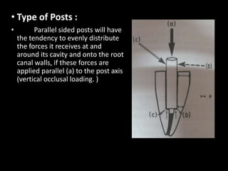 • Type of Posts :
• Parallel sided posts will have
the tendency to evenly distribute
the forces it receives at and
around its cavity and onto the root
canal walls, if these forces are
applied parallel (a) to the post axis
(vertical occlusal loading. )
 