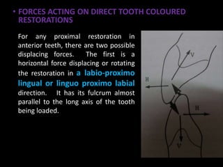 • FORCES ACTING ON DIRECT TOOTH COLOURED
RESTORATIONS
•
For any proximal restoration in
anterior teeth, there are two possible
displacing forces. The first is a
horizontal force displacing or rotating
the restoration in a labio-proximo
lingual or linguo proximo labial
direction. It has its fulcrum almost
parallel to the long axis of the tooth
being loaded.
 