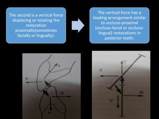 The second is a vertical force
displacing or rotating the
restoration
proximally(sometimes
facially or lingually).
The vertical force has a
loading arrangement similar
to occluso-proximal
(occluso-facial or occluso-
lingual) restorations in
posterior teeth.
 