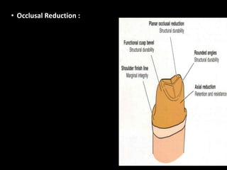 • Occlusal Reduction :
 