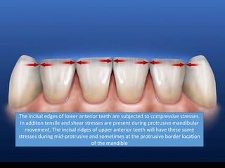 The incisal edges of lower anterior teeth are subjected to compressive stresses.
In additon tensile and shear stresses are present during protrusive mandibular
movement. The incisal ridges of upper anterior teeth will have these same
stresses during mid-protrusive and sometimes at the protrusive border location
of the mandible
 