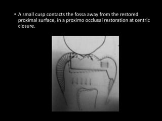 • A small cusp contacts the fossa away from the restored
proximal surface, in a proximo occlusal restoration at centric
closure.
 