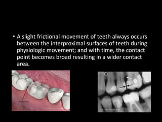 • A slight frictional movement of teeth always occurs
between the interproximal surfaces of teeth during
physiologic movement; and with time, the contact
point becomes broad resulting in a wider contact
area.
 