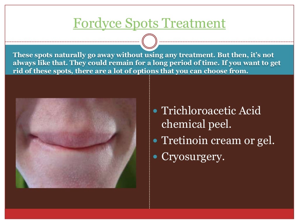 Will Pearly Penile Papules Go Away Will Pearly Penile Papules Go Away