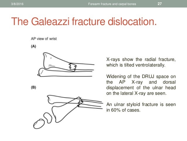 Galeazzi Fracture Classification