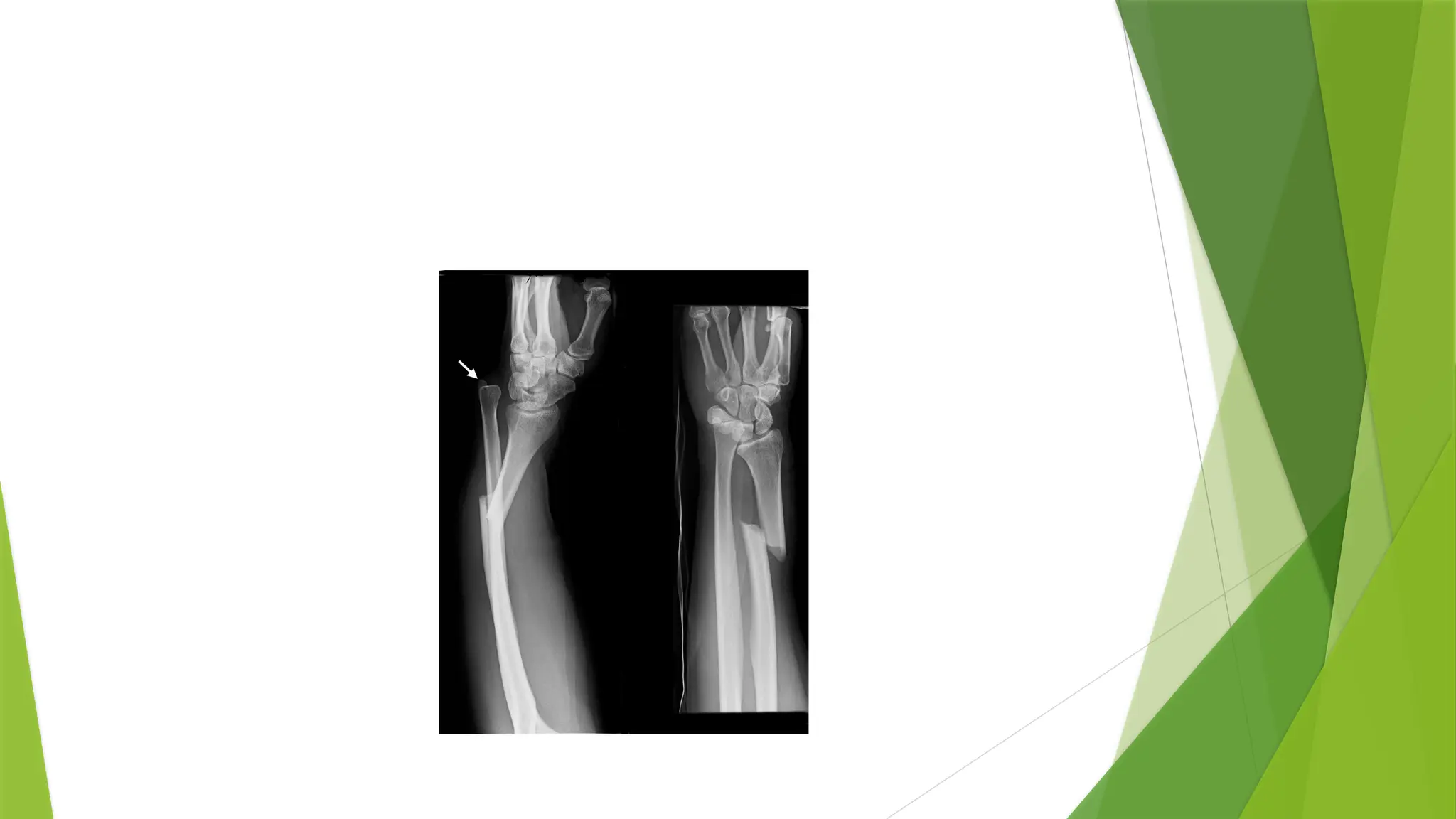 FOREARM_FRACTURES[1].pptx and management | PPTX