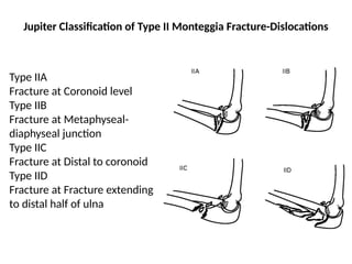 Coronoid Classification Both bones forearm fracture.pptx types and management | PPTX