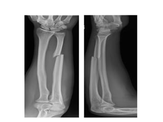 Both bones forearm fracture.pptx types and management | PPTX