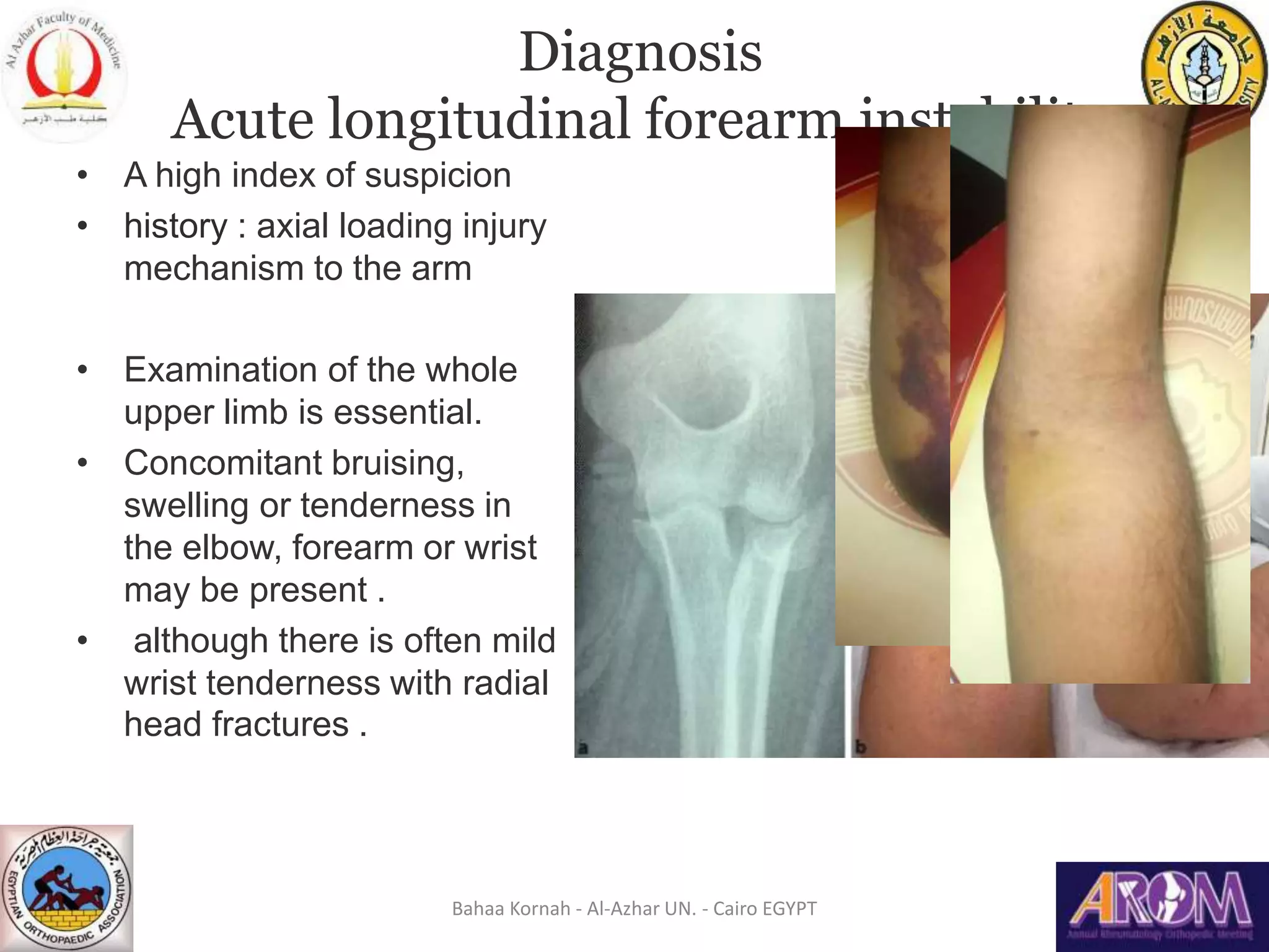 Forearm instability | PPT