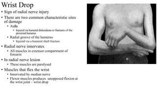 Wrist Drop
• Sign of radial nerve injury
• There are two common characteristic sites
of damage
• Axilla
• Injured viahumeral dislocationsor fractures of the
proximal humerus
• Radial groove of the humerus
• Injured via a humeral shaft fracture
• Radial nerve innervates
• All muscles in extensor compartment of
forearm
• In radial nerve lesion
• These muscles are paralysed
• Muscles that flex the wrist
• Innervated by median nerve
• Flexor muscles produces unopposed flexion at
the wrist joint – wrist drop
 