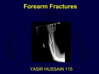 Forearm Fractures
YAS
YAYY
YASIR HUSSAIN 115
 