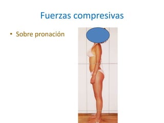Fuerzas compresivas
• Sobre pronación
 