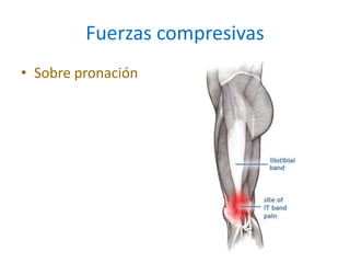 Fuerzas compresivas
• Sobre pronación
 