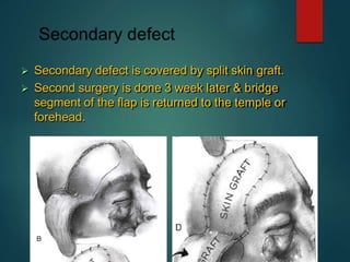  Secondary defect is covered by split skin graft.
 Second surgery is done 3 week later & bridge
segment of the flap is returned to the temple or
forehead.
 