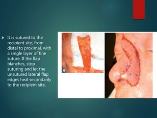  It is sutured to the
recipient site, from
distal to proximal, with
a single layer of fine
suture. If the flap
blanches, stop
suturing and let the
unsutured lateral flap
edges heal secondarily
to the recipient site.
 
