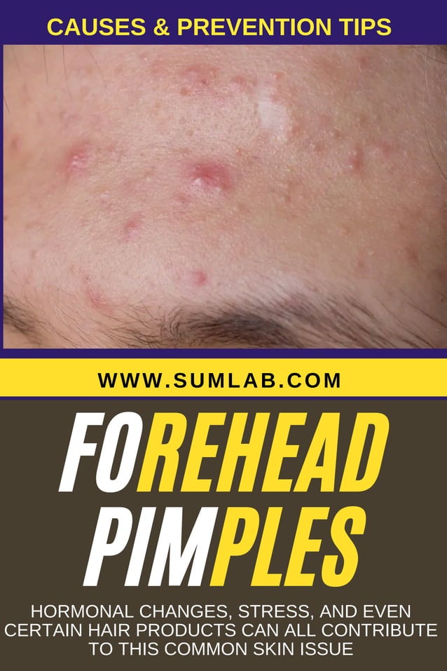 Best Treatment for Forehead Pimples: Your Ultimate Guide to Clear Skin!