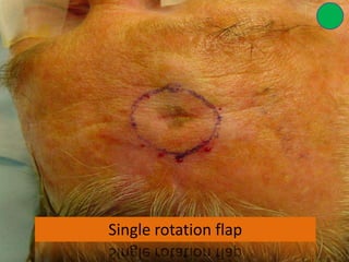 Single Rotation Flap Forehead reconstructionn | PPTX