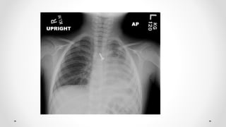 Foreign bodies aero digestive tract | PPTX