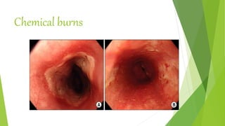 Foreignbodies and chemical burns of the esophagus.pptx