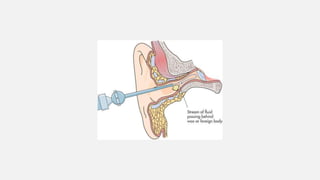Foreign bodies in the ear | PDF