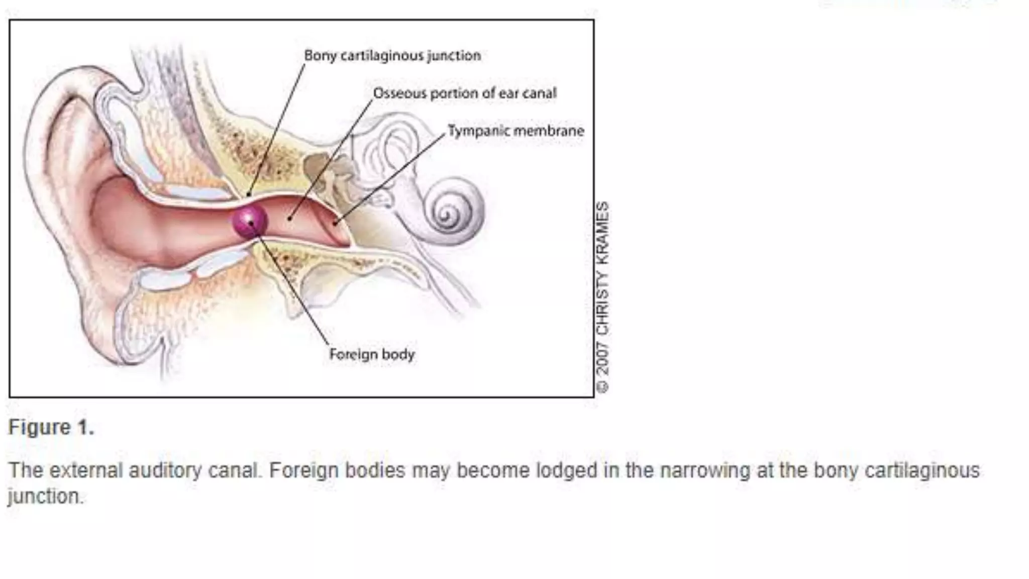 Foreign body in ENT | PPTX