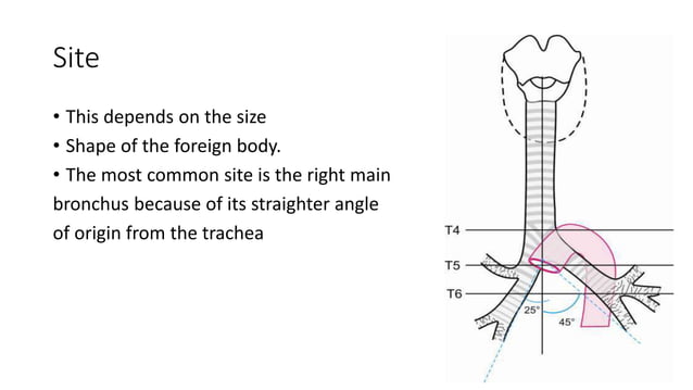 Foreign body in ENT | PPTX