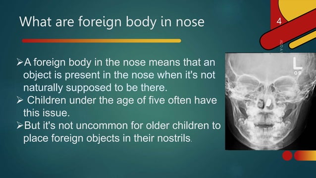 Foreign body in nose by prachi sable .pptx | Ear, Nose and Throat ...